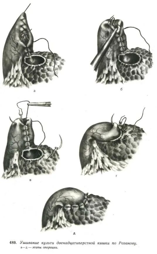 Перфоративная язва 12 кишки. Ушивание перфоративной язвы желудка ход операции. Ушивание прободной язвы двенадцатиперстной кишки. Ушивание перфоративной язвы двенадцатиперстной кишки. Ушивание культи 12 перстной кишки.