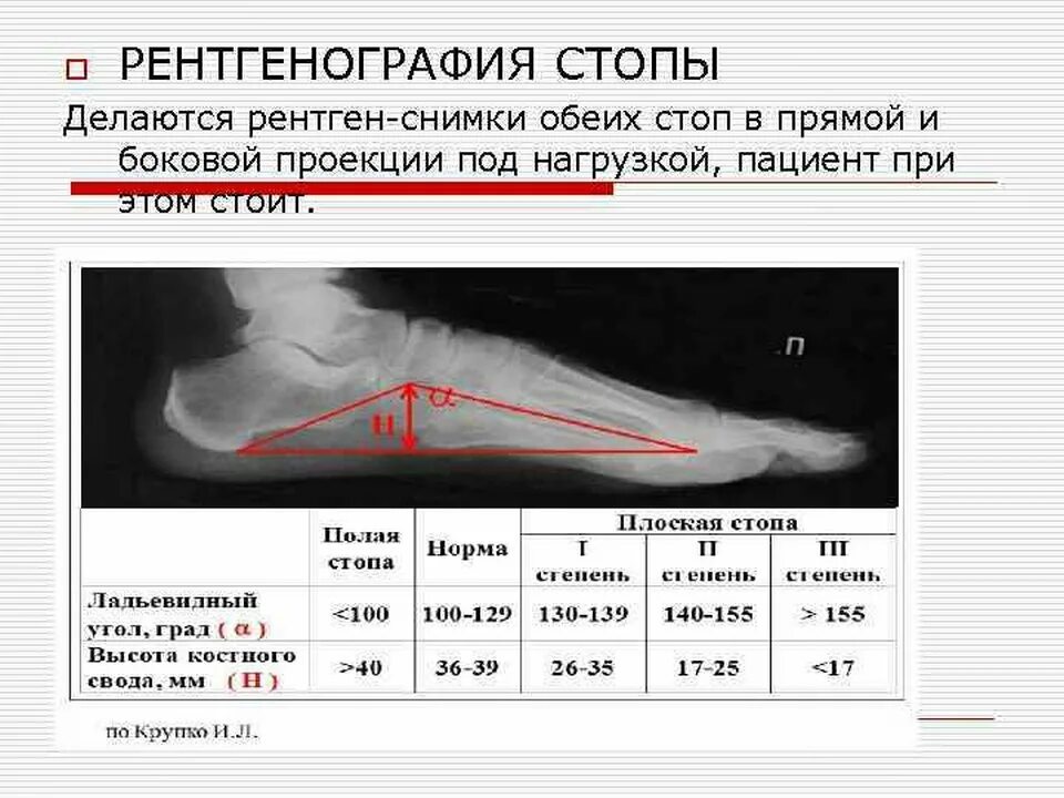 Свод показателей. Плоскостопие продольное схема рентген. 1 Стадия плоскостопия. Методика Богданова плоскостопие рентген. Поперечное плоскостопие 3 степени рентген.