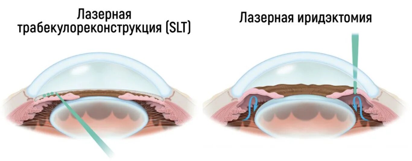 Операция лазерная иридэктомия. Лазерная иридотомия при глаукоме. Лазерная периферическая иридэктомия (глаукома). Глаукома суть операции