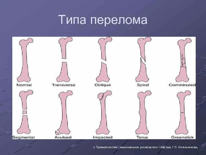 Два типа перелома