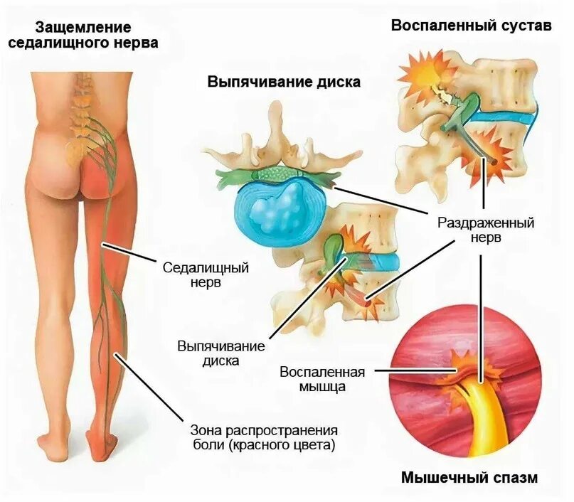 Боль в пояснице отнимается нога