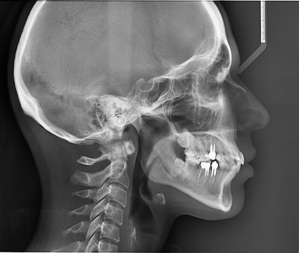 Снимок будут делать. Снимок ТРГ В боковой проекции. Телерентгенограмма черепа (ТРГ).