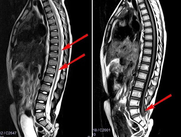 Гидромиелия сирингомиелия. Гидромиелия грудного отдела позвоночника симптомы. Гидромиелия шейного отдела позвоночника мрт. Сирингомиелия шейного отдела позвоночника мрт.