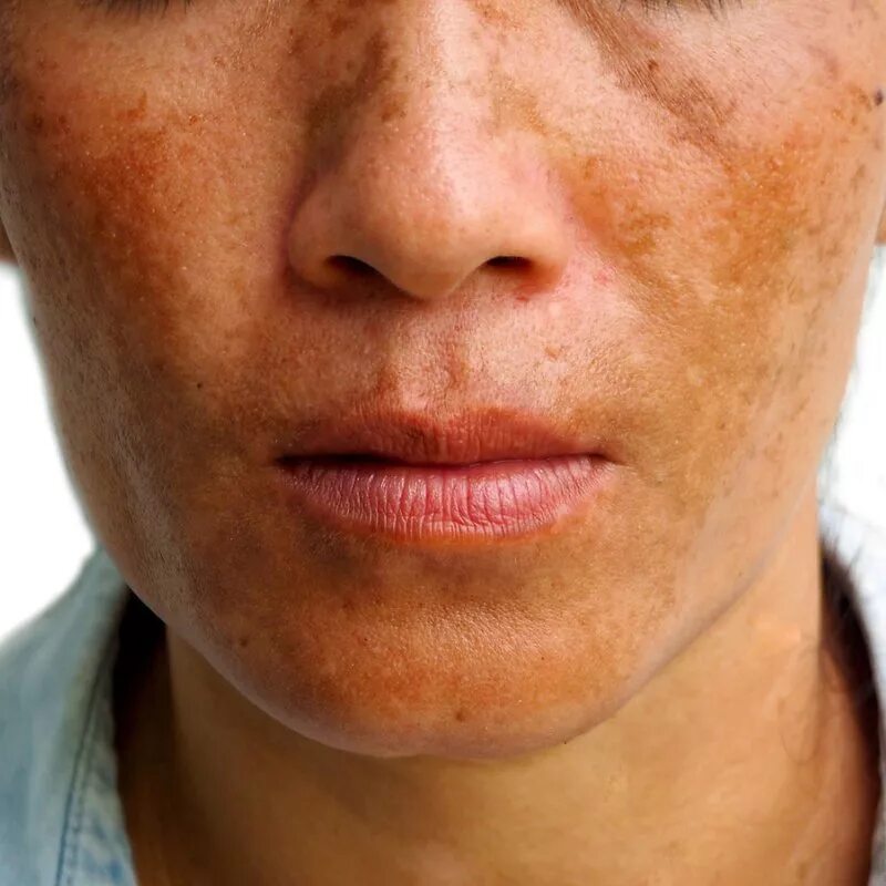 Гиперпигментация мелазма. Пигментные пятна лентиго. Пигмент кожи загар. Пилинг от пигментных пятен до и после. Меланиновая гиперпигментация.