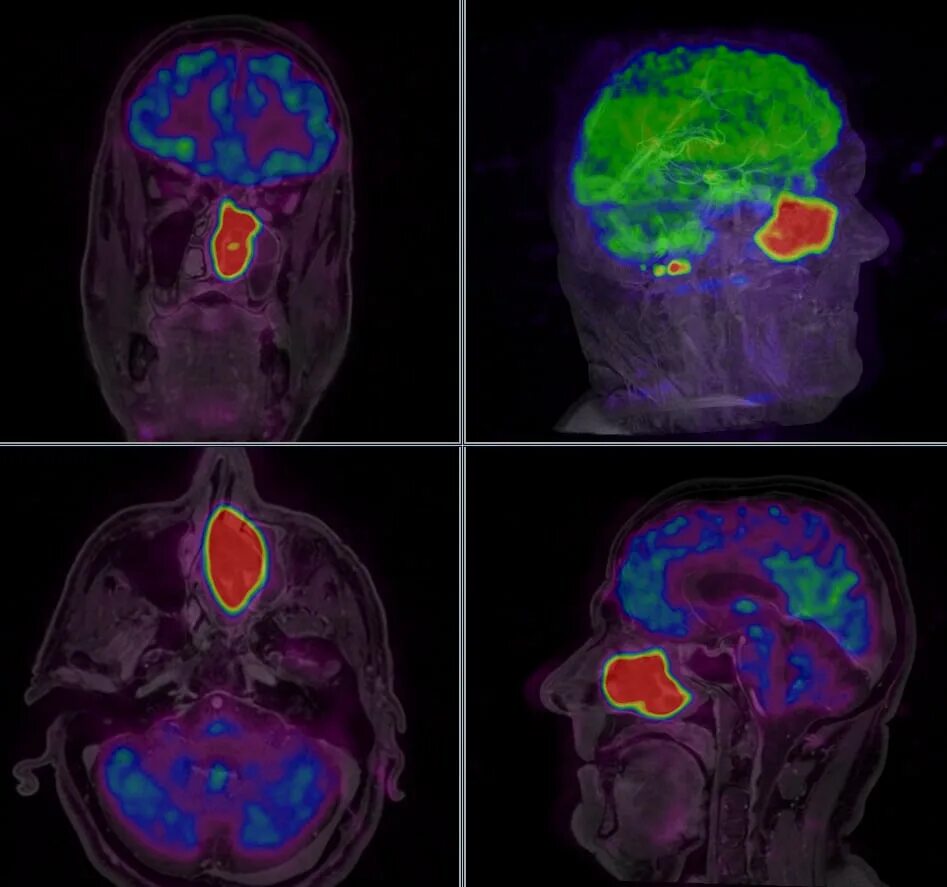 Позитронно-эмиссионная томография (ПЭТ). Позитронно-эмиссионная томография мозга. Позитронно эмиссионная томография при опухоли. Пэт кт или кт что лучше