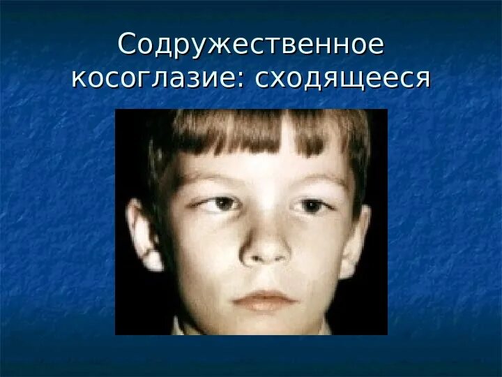 Косоглазие симптомы. Содружественное аккомодационное косоглазие. монолатеральное сходящееся косоглазие. монолатеральное содружественное косоглазие. сходяшиеся косоглазие что такое.