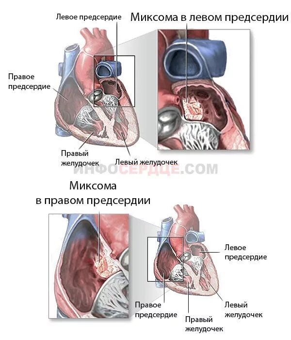 Образование левого предсердия. Миксома левого предсердия операция. Доброкачественная опухоль сердца миксома. Миксома правого желудочка. Миксома сердца клинические рекомендации.