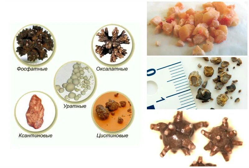 Мочекаменная болезнь классификация. Мочекаменная болезнь камни в мочевом пузыре. Разновидности камней в мочевом пузыре. Уратный -фосфатный камень в почке. Мочекаменная болезнь оксалатные камни.