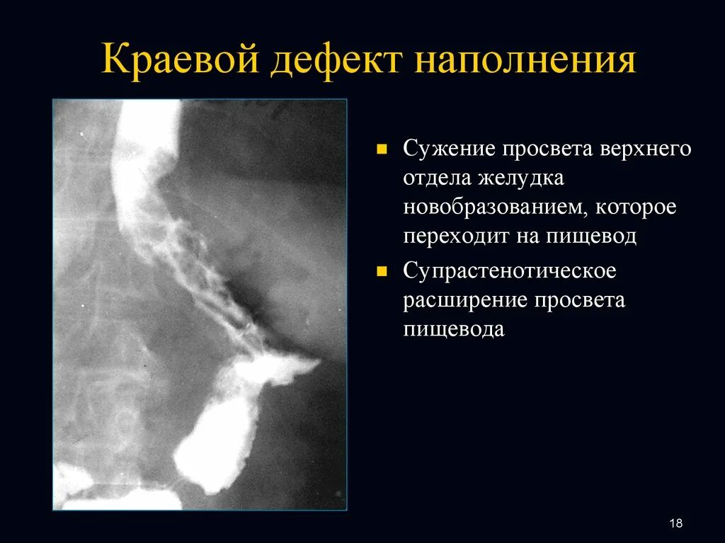 Расширен пищевод желудка. Краевой дефект наполнения желудка рентген. Краевой дефект наполнения пищевода. Дефект заполнения желудка рентген. Краевой дефект наполнения в желудке.