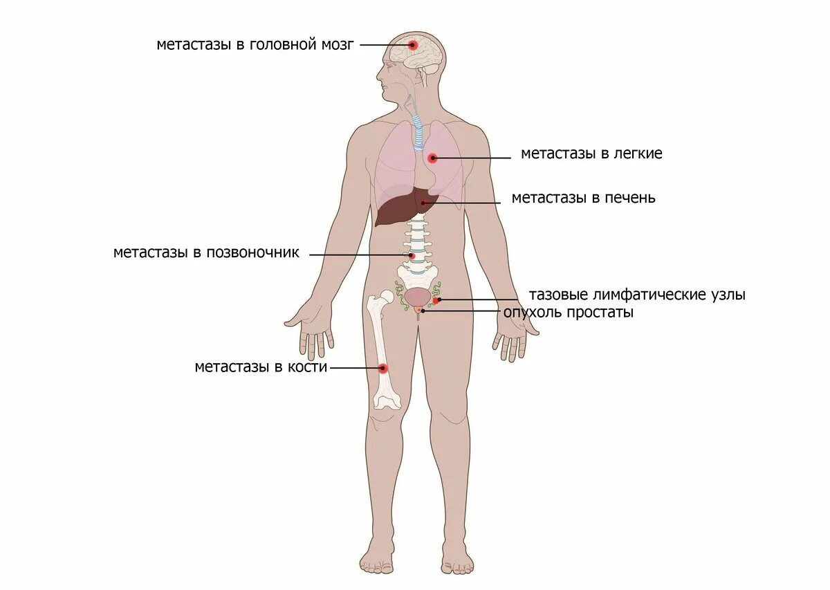 Метастатический рак простаты. Онкологические метастазы.