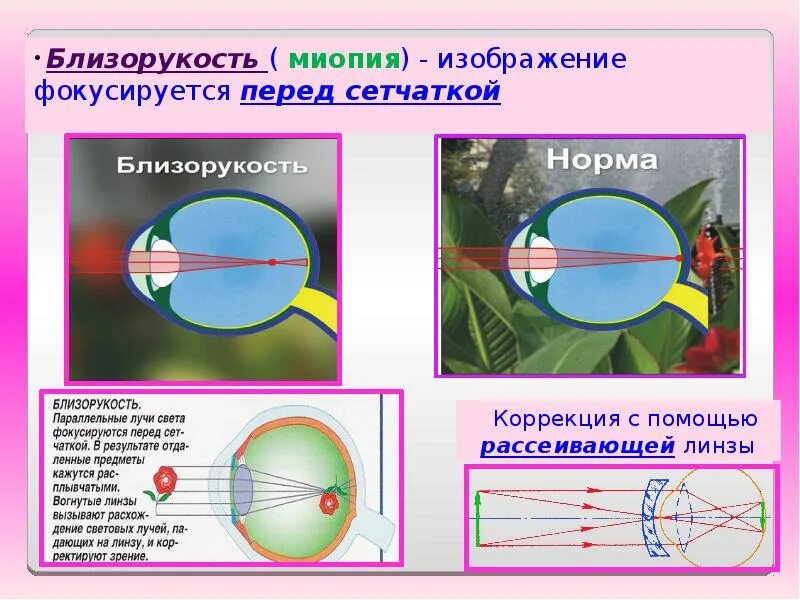 Дальнозоркость и близорукость строение глаза. Фокусировка лучей попадающих в глаз от удаленного предмета рисунок. При миопии лучи фокусируются. При близорукости свет фокусируется. Строение глаза при близорукости и дальнозоркости.