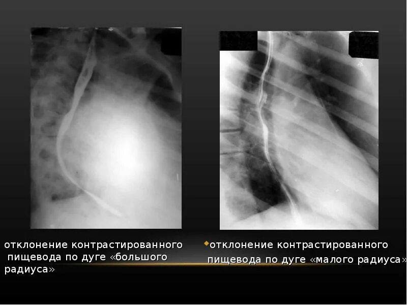 Дуги пищевода. Отклонение пищевода по дуге малого радиуса. Отклонение пищевода по дугам малого и большого радиусов. Отклонение контрастированного пищевода по дуге малого радиуса. Отклонение пищевода рентген.