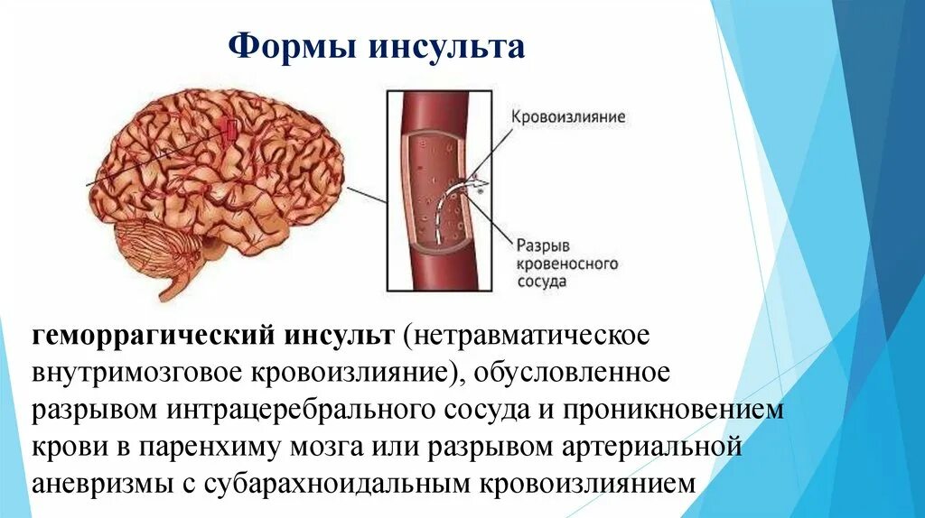 ОНМК геморрагический инсульт симптомы. Геморрагический инсульт внутримозговое кровоизлияние. Геморрагический инсульт разрыв сосуда.