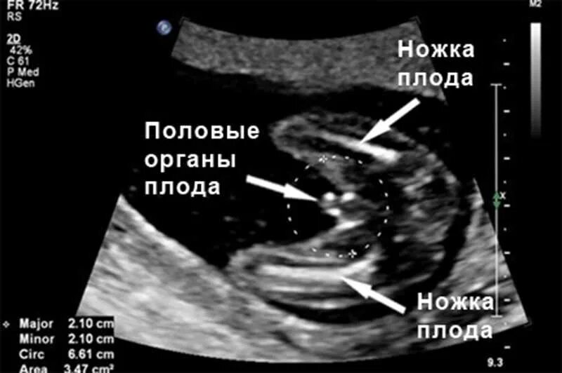 УЗИ на 16-17 неделе беременности пол ребенка. УЗИ на 17 неделе беременности пол ребенка. УЗИ В 12 недель беременности пол ребенка. УЗИ на 17 неделе беременности пол. На 15 неделе можно узнать пол