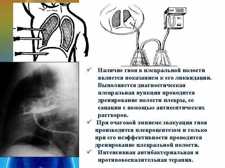 Показания к пункции плевральной полости. Пункция и дренирование плевральной полости. Дренирование эмпиемы плевры. Методика дренирования плевральной полости.