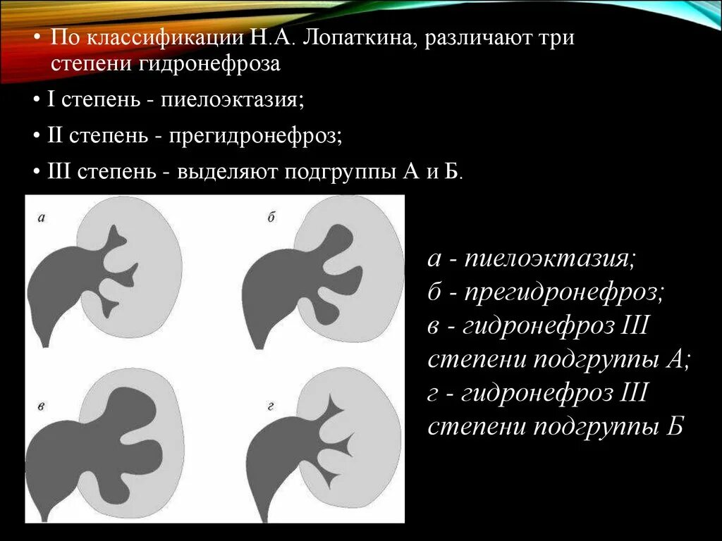 Гидронефроз почки кт стадии. Рентгенологическая классификация гидронефроза. Степени гидронефроза на кт. Классификация гидронефроза по степени.