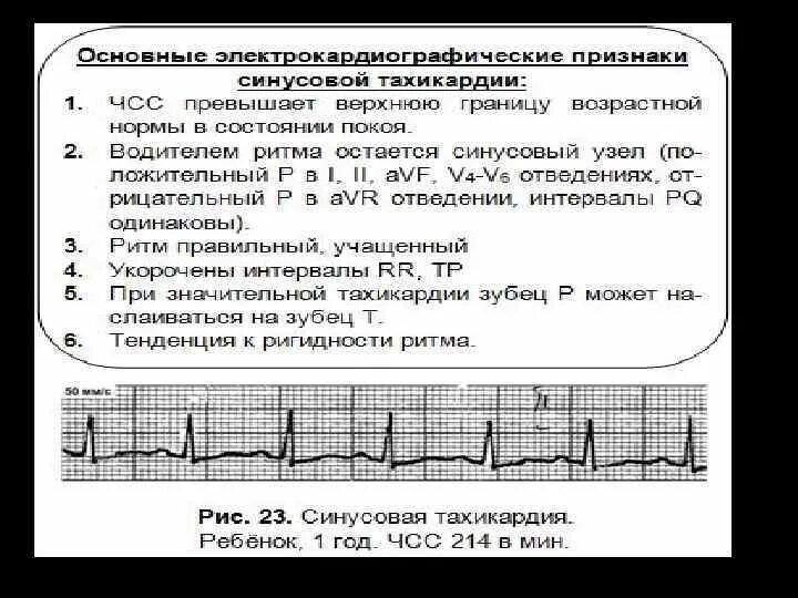 Тахикардия у ребенка 10 лет. Ритм синусовая аритмия у ребенка 1 год. синусовая тахикардия у ребенка 1 год. тахикардия у ребенка 1 год при экг. причины синусовой тахикардии у детей.