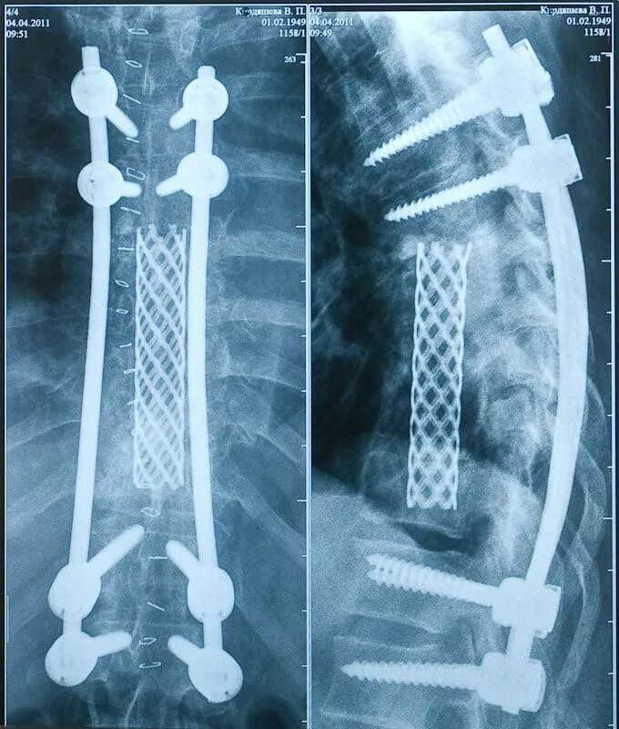 Задний спондилодез с1—с2. Задний спондилодез l5 l6. Передний спондилодез l5. Спондилодез поясничного отдела позвоночника Кейджем. Операция на позвоночник с металлоконструкцией инвалидность