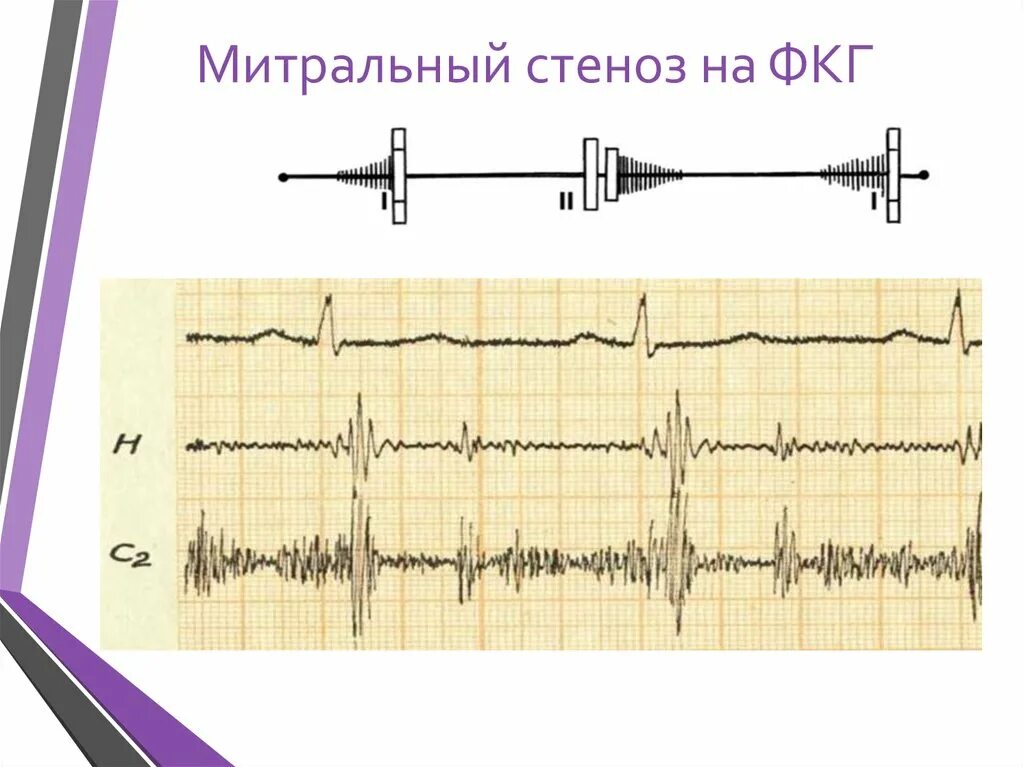 Графическое изображение фкг. Митральный стеноз фонокардиограмма. митральная недостаточность фонокардиограмма. стеноз митрального клапана фонокардиограмма. митральный стеноз фкг.