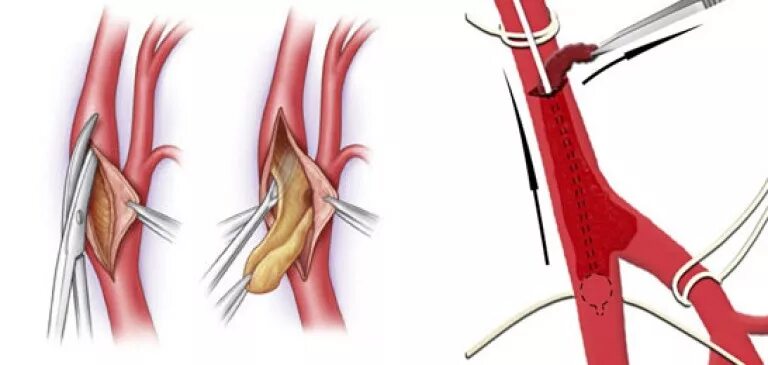 Артерия тромб удаление