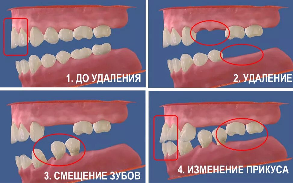 Если нет зуба что можно сделать. Если нет зуба что можно сделать