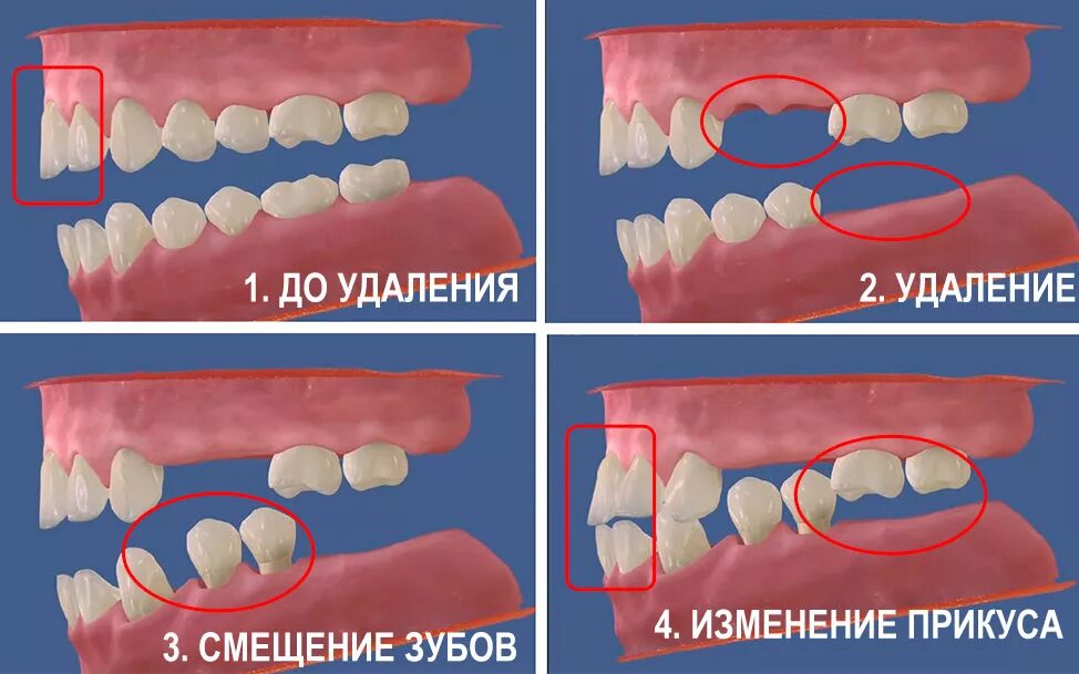 Последствия отсутствия зуба.