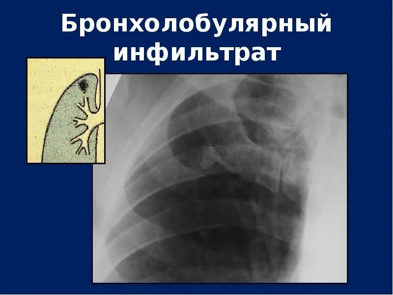 Постинъекционные осложнения внутрикожных инъекций. Лучевая диагностика синдрома инфильтрации легочной ткани. Инфильтрат осложнения. Синдром инфильтрации легочной ткани рентген. Бронхолобулярный инфильтрат рентген.