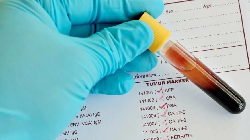 Онкомаркеры. Опухолевые маркеры в крови. Исследование на онкомаркеры. Онкомаркеры картинка. О чем говорят онкомаркеры