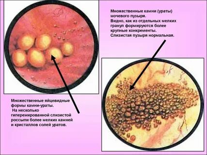 Как убирают камни в мочевом