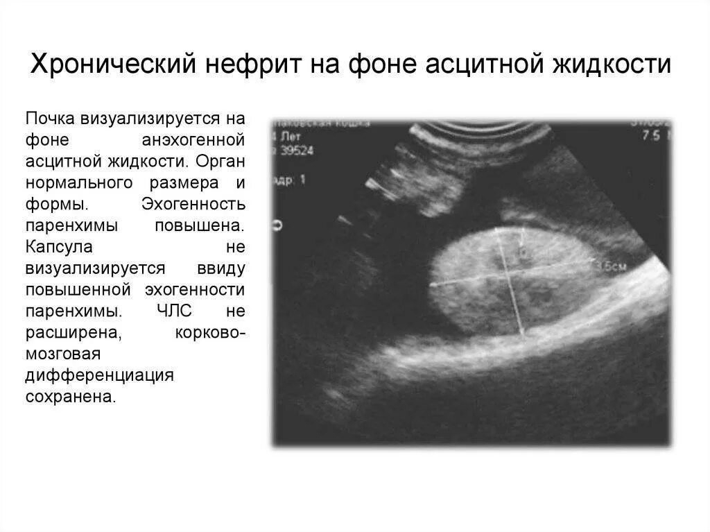 Расширение члс почек на узи. Эхогенность члс. Эхогенность члс. Повышение эхогенности коркового слоя почек. Диабетическая нефропатия узи признаки.