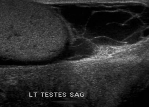 Водянка оболочек яичка УЗИ.
