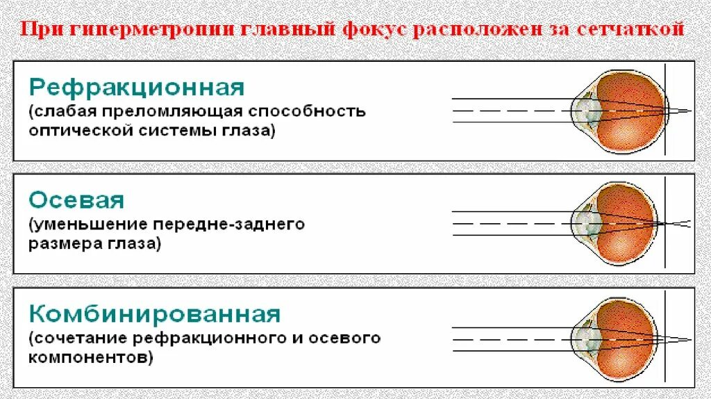 Рефракция в офтальмологии. Виды рефракции зрительного анализатора. периферическая рефракция. современные представления о рефракции. рефракция связей таблица.