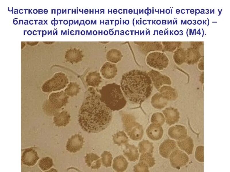 Следы лейкоцитарной эстеразы в моче у женщины