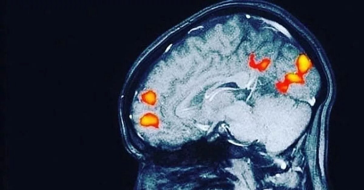 Лечение метастазов мозга. Метастазы в мозг симптомы. Как выглядят метастазы в головном мозге.