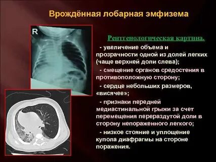 Врожденная долевая эмфизема