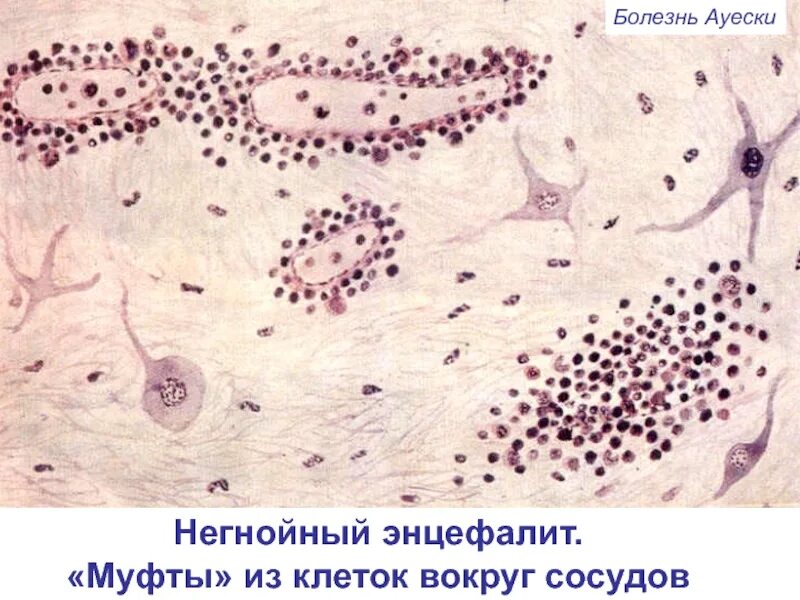 Болезнь ауески у животных. Негнойный лимфоцитарный энцефалит. негнойный энцефалит животных микроскопия. патоморфология негнойного энцефалита;.