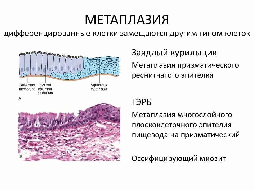 Реактивные изменения клеток метаплазированного эпителия