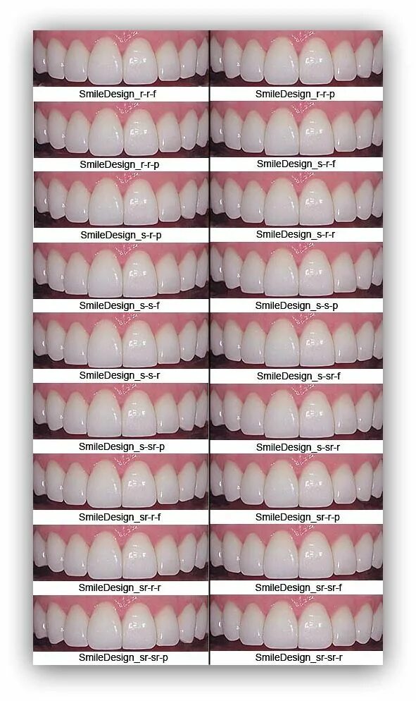 Porcelain Veneers for Teeth Estetica dental, Carillas dentales, Dental