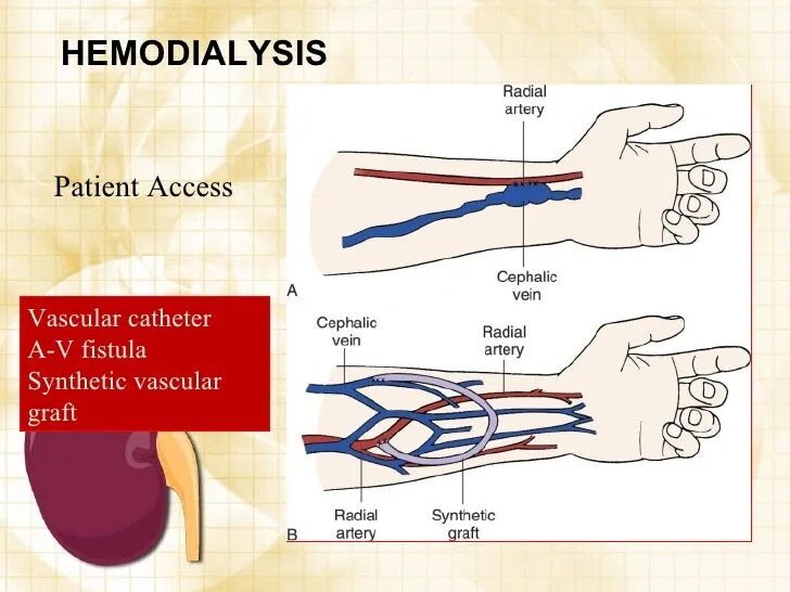 Фистула. Артерио-венозная фистула для гемодиализа. Фистула гемодиализ схема. Наложение артериовенозной фистулы для гемодиализа. Протез фистулы для гемодиализа.