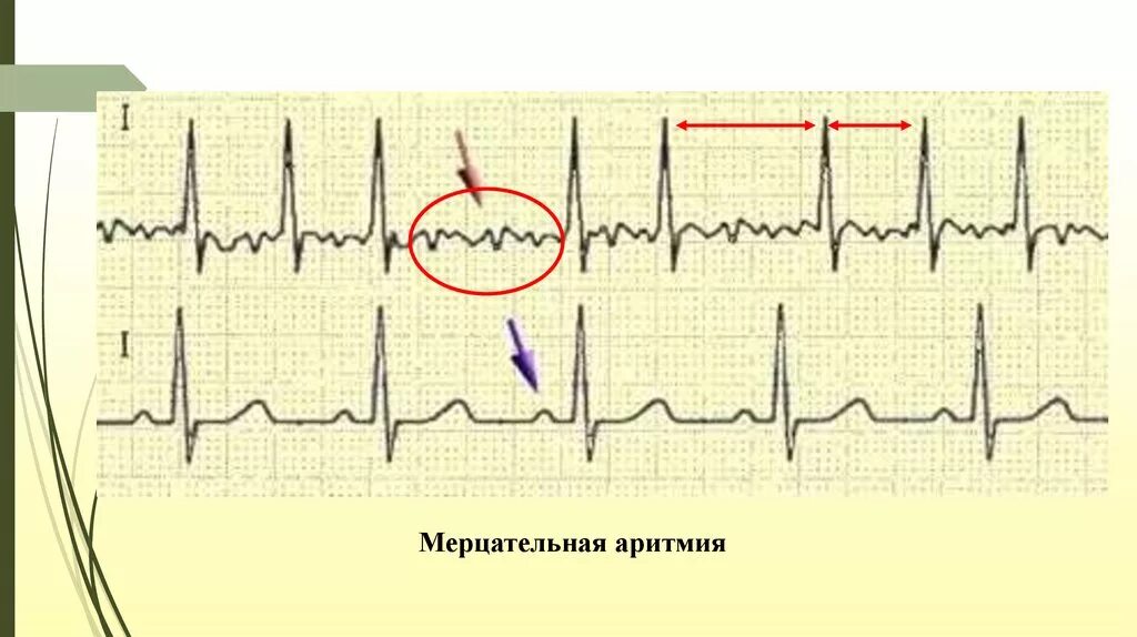 Экг при мерцательной аритмии. Критерии мерцательной аритмии на экг. Ритм сердца при фибрилляции предсердий. Мерцательная отзывы. Мерцательная аритмия мерцание предсердий.