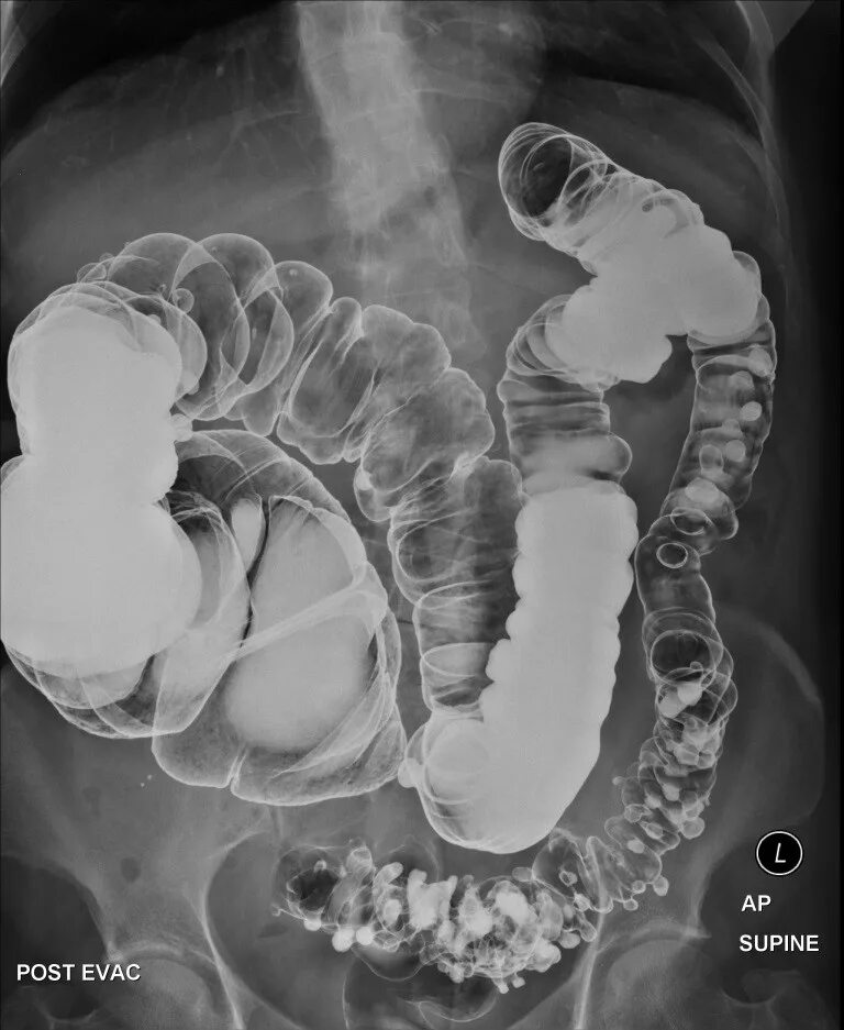 Дивертикулы толстой кишки колоноскопия. Дивертикул кишечника рентген. Острый дивертикулит толстой кишки. Дивертивертикулы сигмовидной кишки. Что такое перфорация кишечника