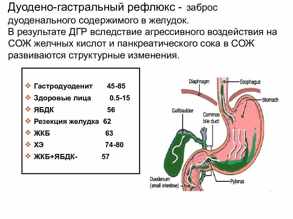 Антральный рефлюкс. Гастроэзофагеальная рефлюксная болезнь ГПОД. Патогенез дуоденогастрального рефлюкса. Рефлюкс дуоденогастральный симптомы. Причиной дуодено гастрального рефлюкса.