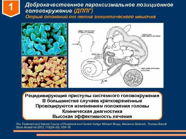 Дппг что это за болезнь. ДППГ доброкачественное пароксизмальное позиционное. Доброкачественное пароксизмальное головокружение. Доброкачественное позиционное головокружение. Доброкачественная головокружение ДППГ.