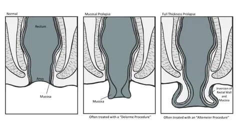 Rectal Prolapse And Treatment.