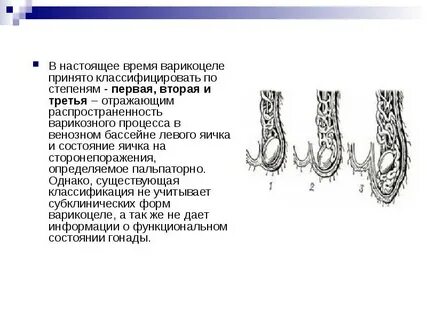 Варикоцеле у мужчин что это