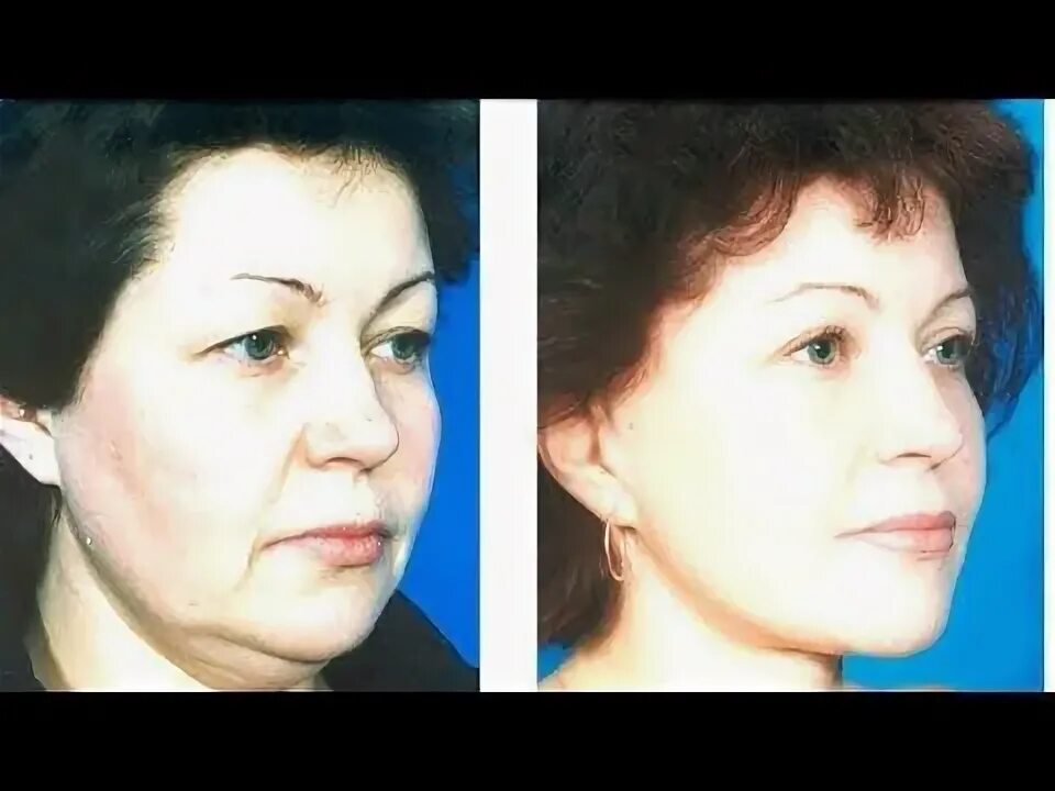 Смас пластика лица