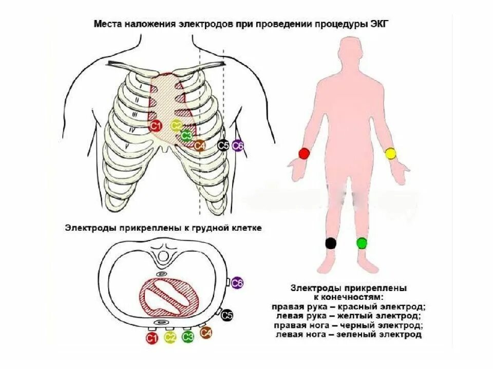 Наложение электродов при ЭКГ схема наложения. Правила наложения электродов ЭКГ. Наложения электродов ЭКГ рисунок. Схема наложения электродов при снятии ЭКГ. Как делают экг взрослым