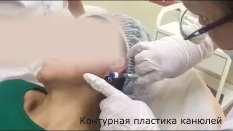 Гиалуроновая кислота канюлей