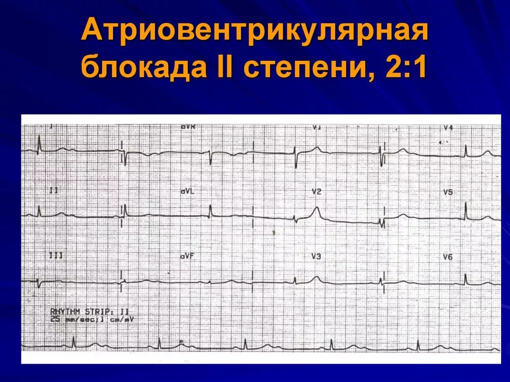 Атриовентрикулярная блокада 2. ЭКГ атриовентрикулярная блокада Мобиц 2. Атриовентрикулярная блокада Мобиц 1 ЭКГ. Av блокада 2 степени 3 ти. АВ блокада 2 степени Мобиц 1 на ЭКГ.