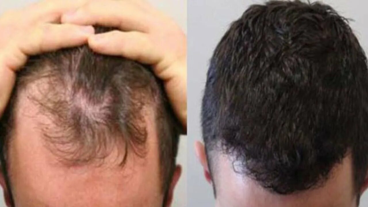 Соч что это. Плазмолифтинг алопеция. Плазмолифтинг для волос мужчинам. Плазмотерапия для волос до и после мужчины. Плазмолифтинг головы для волос.